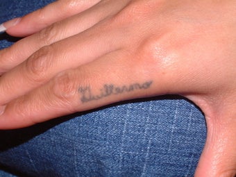 Tattoo Removal