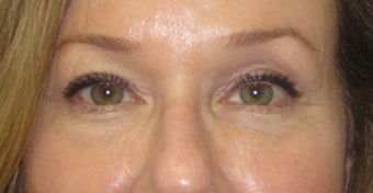 Lower lid bags treated with fillers to tear trough area and midface 