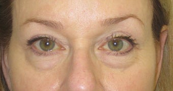 Lower lid bags treated with fillers to tear trough area and midface 