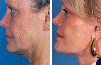 Facelift