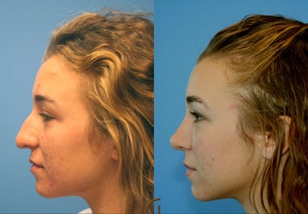 Dorsal Hump Reduction