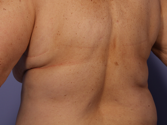 CoolSculpting by Zeltiq to Bra Rolls/Back Fat