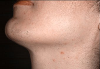 Laser hair removal in Middle-Easterner