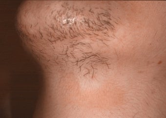 Laser hair removal in Middle-Easterner