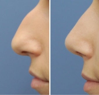 Rhinoplasty