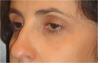 Restylane