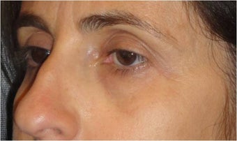 Restylane