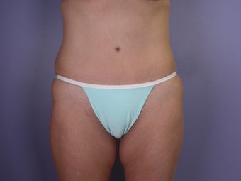 Bodylift