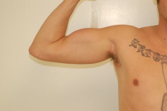 Arm Implants
