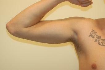 Arm Implants