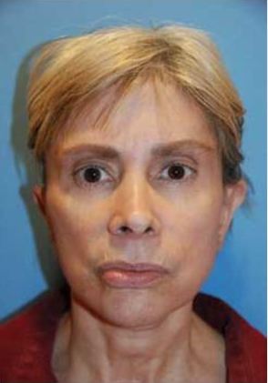 Otoplasty Ear Plastic Surgery Revision