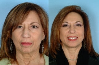 Facelift