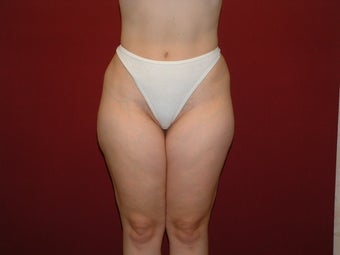 Traditional Liposuction