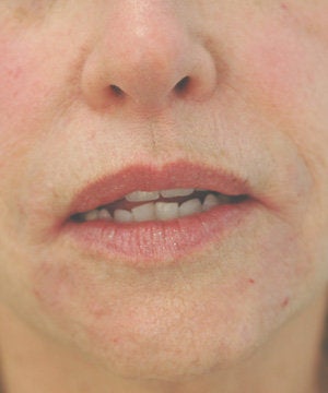 Perlane injections for chin assymmetry 
