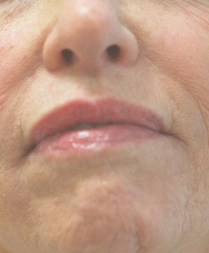 Perlane injections for chin assymmetry 