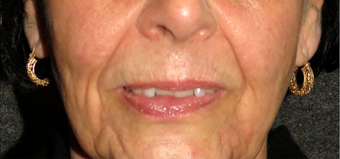 Non-surgical Lip Augmentation