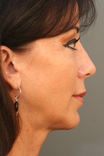 Female Chin Implant