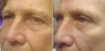 63 Year Old Man Before and After Lower Eyelid Surgery