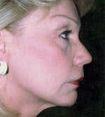 Neck Liposuction