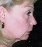 Neck Liposuction