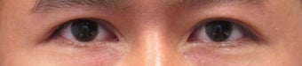 Revision Bilateral Asian Eyelid Surgery
