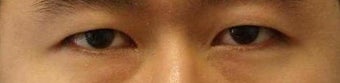 Revision Bilateral Asian Eyelid Surgery