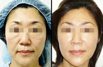 Ultherapy + Fat Transfer
