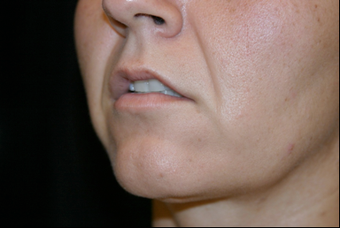 Upper Lip Lift or Lips 