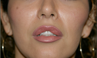 Upper Lip Lift or Lips 