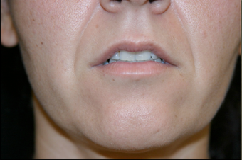 Upper Lip Lift or Lips 