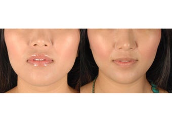 Botox Jawline Reduction