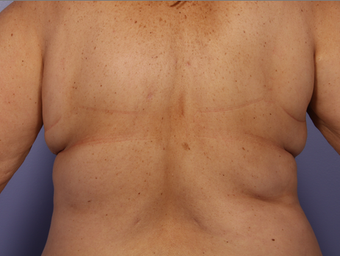 CoolSculpting by Zeltiq to Bra Rolls