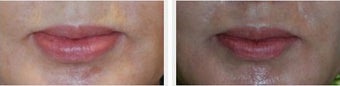 Lip Thinning Reduction