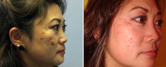 Treatment of Melasma