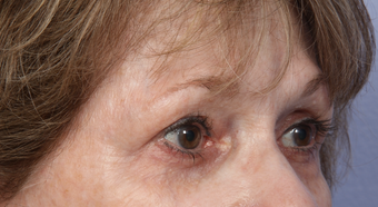 Eyelid Surgery