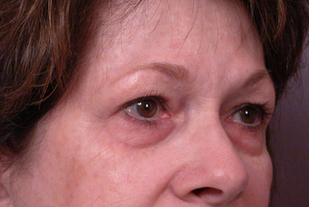 Eyelid Surgery