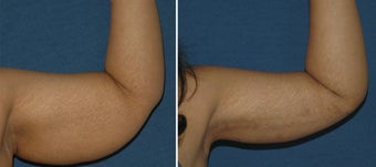 Brachioplasty 