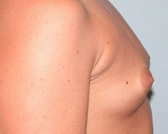 Breast Augmentation