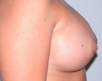 Breast Augmentation