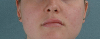 Microfat Lip Injections
