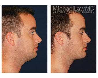 Chin Liposuction - Lower Facial Rejuvenation