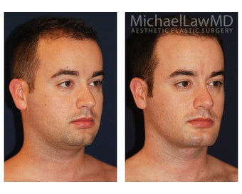 Chin Liposuction - Lower Facial Rejuvenation