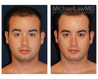 Chin Liposuction - Lower Facial Rejuvenation