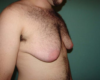 FTM "Top Surgery" for chest masculinization