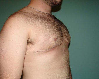 FTM "Top Surgery" for chest masculinization