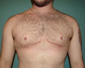 FTM "Top Surgery" for chest masculinization