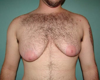 FTM "Top Surgery" for chest masculinization