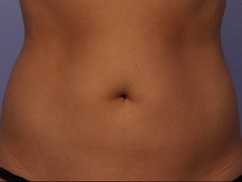 CoolSculpting by Zeltiq to Adbomen