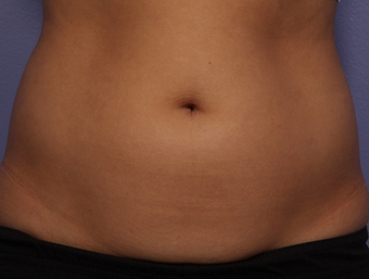 CoolSculpting by Zeltiq to Adbomen