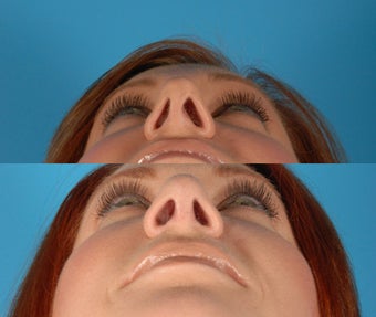 Rhinoplasty